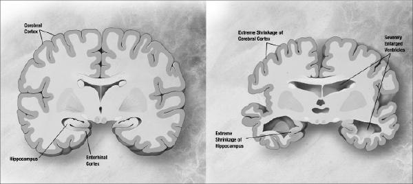 The symptoms of Alzheimer’s are caused by the physical degeneration of the brain (right side).